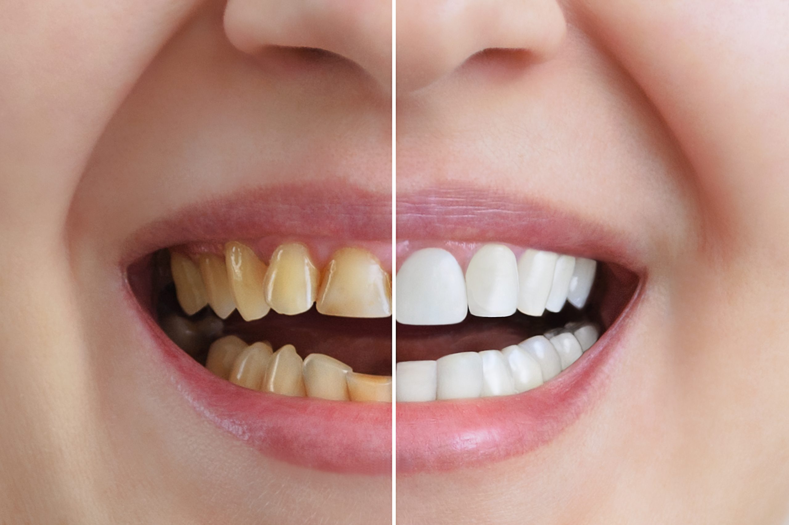 What is the Best Way to Whiten Teeth?